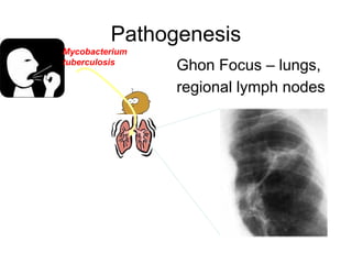 Pathogenesis
Ghon Focus – lungs,
regional lymph nodes
Mycobacterium
tuberculosis
 