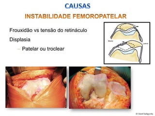 Frouxidão vs tensão do retináculo
Displasia
– Patelar ou troclear
Dr David Sadigursky
 