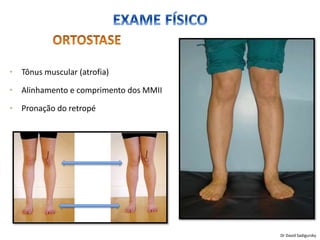 • Tônus muscular (atrofia)
• Alinhamento e comprimento dos MMII
• Pronação do retropé
Dr David Sadigursky
 