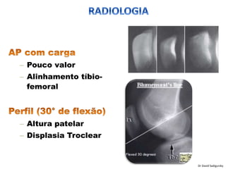 – Pouco valor
– Alinhamento tíbio-
femoral
– Altura patelar
– Displasia Troclear
Dr David Sadigursky
 