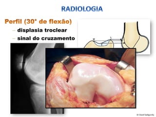 – displasia troclear
– sinal do cruzamento
Dr David Sadigursky
 
