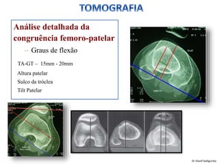 Análise detalhada da
congruência femoro-patelar
– Graus de flexão
TA-GT – 15mm - 20mm
Altura patelar
Sulco da tróclea
Tilt Patelar
Dr David Sadigursky
 