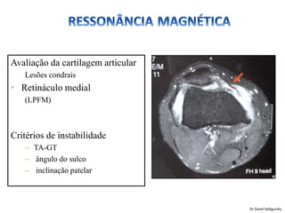 Avaliação da cartilagem articular
Lesões condrais
• Retináculo medial
(LPFM)
Critérios de instabilidade
– TA-GT
– ângulo do sulco
– inclinação patelar
Dr David Sadigursky
 