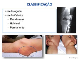 Luxação aguda
Luxação Crônica
– Recidivante
– Habitual
– Permanente
Dr David Sadigursky
 