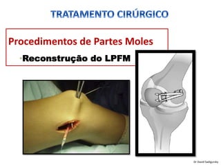 Procedimentos de Partes Moles
•Reconstrução do LPFM
Dr David Sadigursky
 