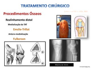 Procedimentos Ósseos
Realinhamento distal
Medialização da TAT
Antero-medialização
Máximo de 15mm
Dr David Sadigursky
 