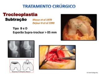 Trocleoplastia
Subtração
Tipo B e D
Esporão Supra-troclear > 05 mm
Dr David Sadigursky
 