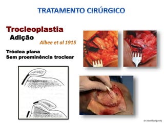 Trocleoplastia
Adição
Tróclea plana
Sem proeminência troclear
Dr David Sadigursky
 