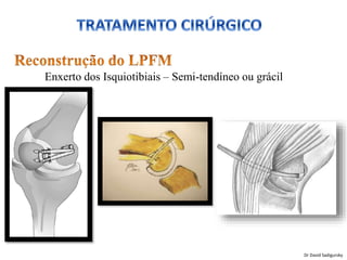 Enxerto dos Isquiotibiais – Semi-tendíneo ou grácil
Dr David Sadigursky
 