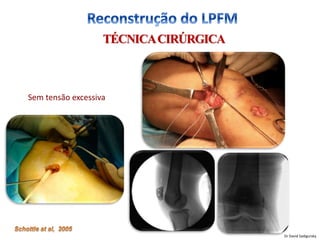 TÉCNICACIRÚRGICA
Sem tensão excessiva
Dr David Sadigursky
 