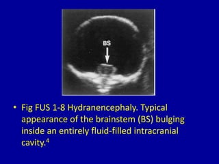 • Fig FUS 1-8 Hydranencephaly. Typical
appearance of the brainstem (BS) bulging
inside an entirely fluid-filled intracranial
cavity.4
 