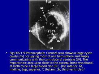 • Fig FUS 1-9 Porencephaly. Coronal scan shows a large cystic
cavity (Cy) occupying most of one hemisphere and amply
communicating with the contralateral ventricle (LV). The
hyperechoic area seen close to the parietal bone was found
at birth to be a large blood clot (BC). (Inf, inferior; M,
midline; Sup, superior; T, thalami; 3v, third ventricle.)2
 