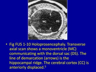• Fig FUS 1-10 Holoprosencephaly. Transverse
axial scan shows a monoventricle (MC)
communicating with the dorsal sac (DS). The
line of demarcation (arrows) is the
hippocampal ridge. The cerebral cortex (CC) is
anteriorly displaced.5
 