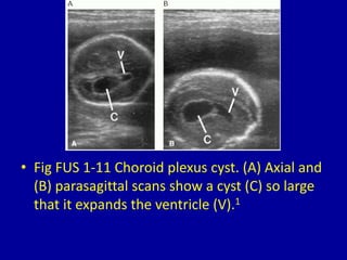 • Fig FUS 1-11 Choroid plexus cyst. (A) Axial and
(B) parasagittal scans show a cyst (C) so large
that it expands the ventricle (V).1
 