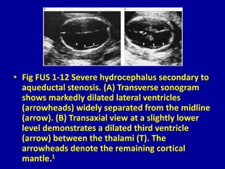 • Fig FUS 1-12 Severe hydrocephalus secondary to
aqueductal stenosis. (A) Transverse sonogram
shows markedly dilated lateral ventricles
(arrowheads) widely separated from the midline
(arrow). (B) Transaxial view at a slightly lower
level demonstrates a dilated third ventricle
(arrow) between the thalami (T). The
arrowheads denote the remaining cortical
mantle.1
 