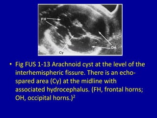 • Fig FUS 1-13 Arachnoid cyst at the level of the
interhemispheric fissure. There is an echo-
spared area (Cy) at the midline with
associated hydrocephalus. (FH, frontal horns;
OH, occipital horns.)2
 