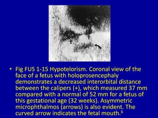 • Fig FUS 1-15 Hypotelorism. Coronal view of the
face of a fetus with holoprosencephaly
demonstrates a decreased interorbital distance
between the calipers (+), which measured 37 mm
compared with a normal of 52 mm for a fetus of
this gestational age (32 weeks). Asymmetric
microphthalmos (arrows) is also evident. The
curved arrow indicates the fetal mouth.6
 