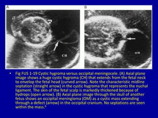 • Fig FUS 1-19 Cystic hygroma versus occipital meningocele. (A) Axial plane
image shows a huge cystic hygroma (CH) that extends from the fetal neck
to envelop the fetal head (curved arrow). Note the characteristic midline
septation (straight arrow) in the cystic hygroma that represents the nuchal
ligament. The skin of the fetal scalp is markedly thickened because of
hydrops (open arrow). (B) Axial plane image through the skull of another
fetus shows an occipital meningioma (OM) as a cystic mass extending
through a defect (arrow) in the occipital cranium. No septations are seen
within the mass.6
 