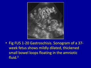 • Fig FUS 1-20 Gastroschisis. Sonogram of a 37-
week fetus shows mildly dilated, thickened
small bowel loops floating in the amniotic
fluid.3
 