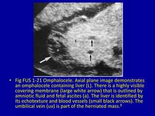 • Fig FUS 1-21 Omphalocele. Axial plane image demonstrates
an omphalocele containing liver (L). There is a highly visible
covering membrane (large white arrow) that is outlined by
amniotic fluid and fetal ascites (a). The liver is identified by
its echotexture and blood vessels (small black arrows). The
umbilical vein (uv) is part of the herniated mass.8
 