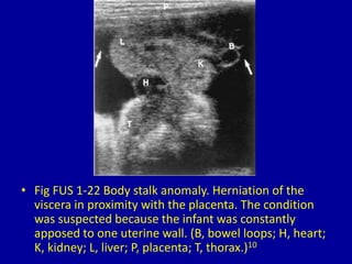 • Fig FUS 1-22 Body stalk anomaly. Herniation of the
viscera in proximity with the placenta. The condition
was suspected because the infant was constantly
apposed to one uterine wall. (B, bowel loops; H, heart;
K, kidney; L, liver; P, placenta; T, thorax.)10
 