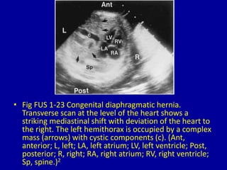 • Fig FUS 1-23 Congenital diaphragmatic hernia.
Transverse scan at the level of the heart shows a
striking mediastinal shift with deviation of the heart to
the right. The left hemithorax is occupied by a complex
mass (arrows) with cystic components (c). (Ant,
anterior; L, left; LA, left atrium; LV, left ventricle; Post,
posterior; R, right; RA, right atrium; RV, right ventricle;
Sp, spine.)2
 