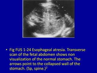• Fig FUS 1-24 Esophageal atresia. Transverse
scan of the fetal abdomen shows non
visualization of the normal stomach. The
arrows point to the collapsed wall of the
stomach. (Sp, spine.)2
 