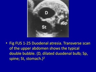• Fig FUS 1-25 Duodenal atresia. Transverse scan
of the upper abdomen shows the typical
double bubble. (D, dilated duodenal bulb; Sp,
spine; St, stomach.)2
 