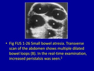 • Fig FUS 1-26 Small bowel atresia. Transverse
scan of the abdomen shows multiple dilated
bowel loops (B). In the real-time examination,
increased peristalsis was seen.2
 
