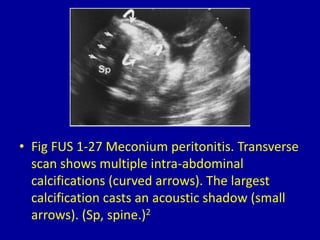 • Fig FUS 1-27 Meconium peritonitis. Transverse
scan shows multiple intra-abdominal
calcifications (curved arrows). The largest
calcification casts an acoustic shadow (small
arrows). (Sp, spine.)2
 