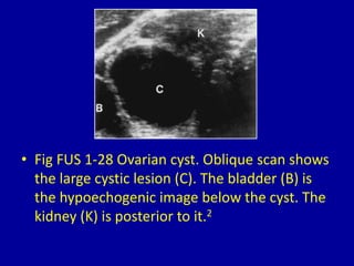 • Fig FUS 1-28 Ovarian cyst. Oblique scan shows
the large cystic lesion (C). The bladder (B) is
the hypoechogenic image below the cyst. The
kidney (K) is posterior to it.2
 