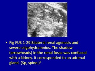 • Fig FUS 1-29 Bilateral renal agenesis and
severe oligohydramnios. The shadow
(arrowheads) in the renal fossa was confused
with a kidney. It corresponded to an adrenal
gland. (Sp, spine.)2
 