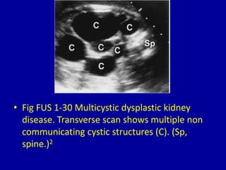 • Fig FUS 1-30 Multicystic dysplastic kidney
disease. Transverse scan shows multiple non
communicating cystic structures (C). (Sp,
spine.)2
 