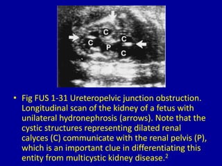 • Fig FUS 1-31 Ureteropelvic junction obstruction.
Longitudinal scan of the kidney of a fetus with
unilateral hydronephrosis (arrows). Note that the
cystic structures representing dilated renal
calyces (C) communicate with the renal pelvis (P),
which is an important clue in differentiating this
entity from multicystic kidney disease.2
 