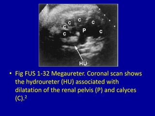 • Fig FUS 1-32 Megaureter. Coronal scan shows
the hydroureter (HU) associated with
dilatation of the renal pelvis (P) and calyces
(C).2
 