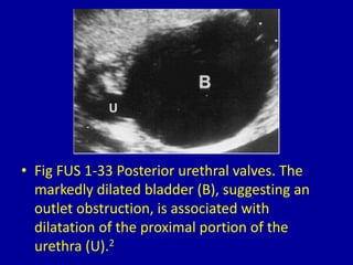 • Fig FUS 1-33 Posterior urethral valves. The
markedly dilated bladder (B), suggesting an
outlet obstruction, is associated with
dilatation of the proximal portion of the
urethra (U).2
 