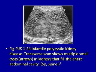 • Fig FUS 1-34 Infantile polycystic kidney
disease. Transverse scan shows multiple small
cysts (arrows) in kidneys that fill the entire
abdominal cavity. (Sp, spine.)2
 