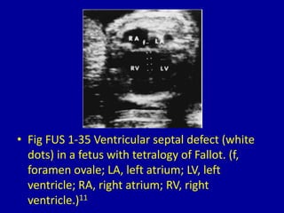• Fig FUS 1-35 Ventricular septal defect (white
dots) in a fetus with tetralogy of Fallot. (f,
foramen ovale; LA, left atrium; LV, left
ventricle; RA, right atrium; RV, right
ventricle.)11
 