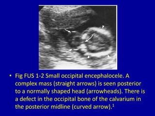 • Fig FUS 1-2 Small occipital encephalocele. A
complex mass (straight arrows) is seen posterior
to a normally shaped head (arrowheads). There is
a defect in the occipital bone of the calvarium in
the posterior midline (curved arrow).1
 