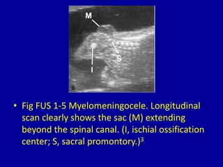 • Fig FUS 1-5 Myelomeningocele. Longitudinal
scan clearly shows the sac (M) extending
beyond the spinal canal. (I, ischial ossification
center; S, sacral promontory.)3
 
