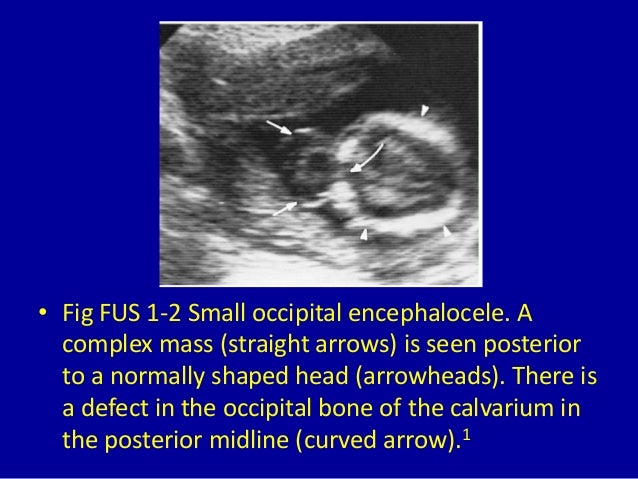 The Anomalies Of Fetus Ultrasound