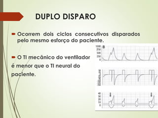 DUPLO DISPARO
 Ocorrem dois ciclos consecutivos disparados
pelo mesmo esforço do paciente.
 O TI mecânico do ventilador
é menor que o TI neural do
paciente.
 