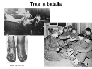 Tras la batalla
Soldier with trench foot
 
