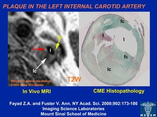 PLAQUE IN THE LEFT INTERNAL CAROTID ARTERY
T2W
CME HistopathologyIn Vivo MRI
450µm in-plane resolution
3 mm slice thickness
Fayad Z.A. and Fuster V. Ann. NY Acad. Sci. 2000;902:173-186
Imaging Science Laboratories
Mount Sinai School of Medicine
 