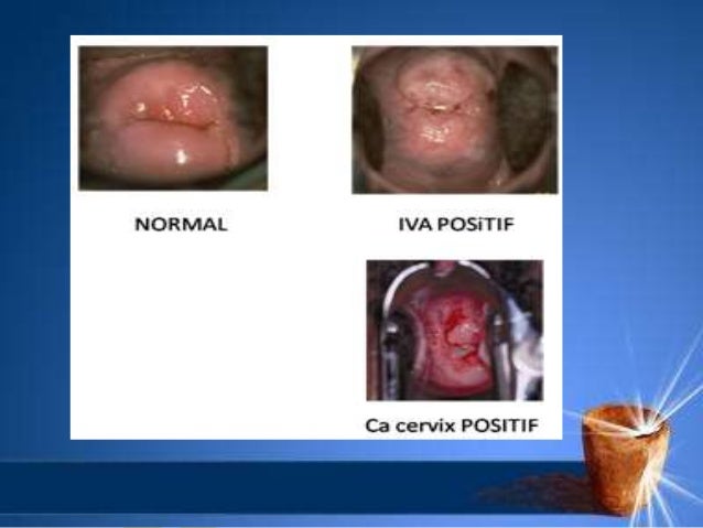 Inspeksi visual dengan asam asetat
