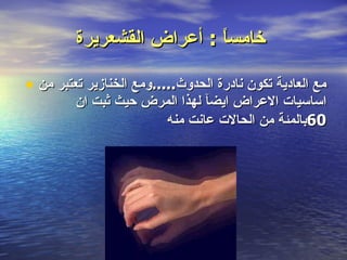 خامساً  :  أعراض القشعريرة   مع العادية تكون نادرة الحدوث ..... ومع الخنازير تعتبر من اساسيات الاعراض ايضآ لهذا المرض حيث ثبت ان  60 بالمئة من الحالات عانت منه 