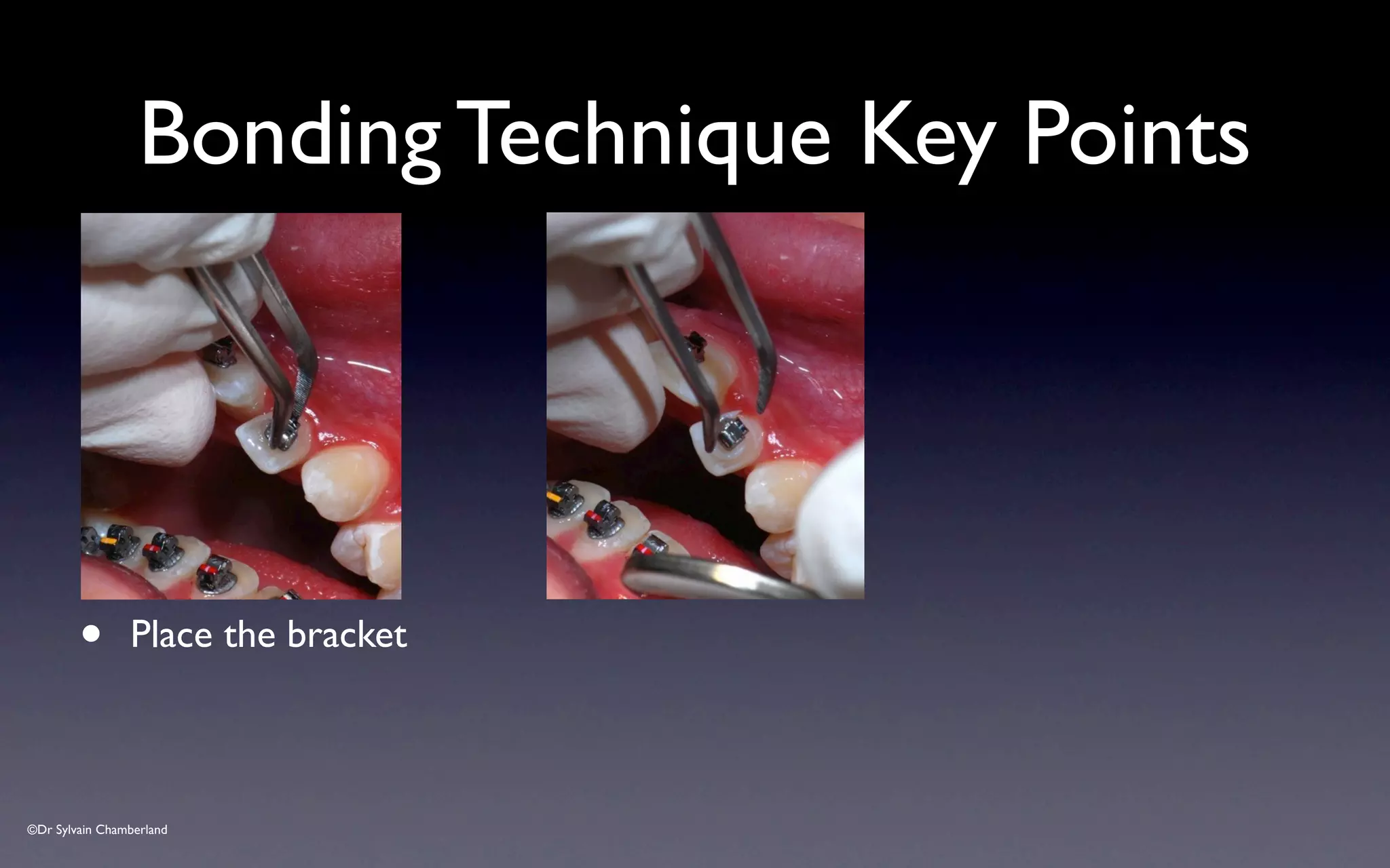 ©Dr Sylvain Chamberland
Bonding Technique Key Points
• Place the bracket
 