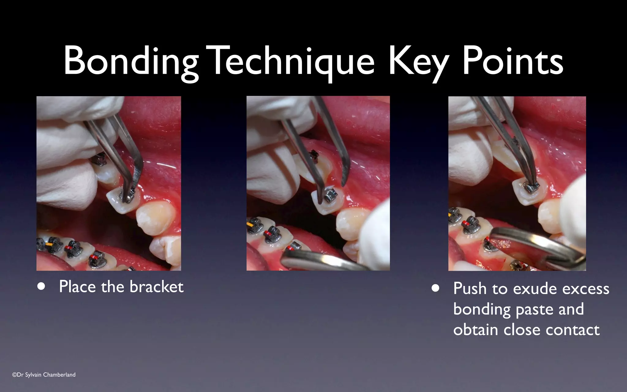 ©Dr Sylvain Chamberland
Bonding Technique Key Points
• Place the bracket • Push to exude excess
bonding paste and
obtain close contact
 