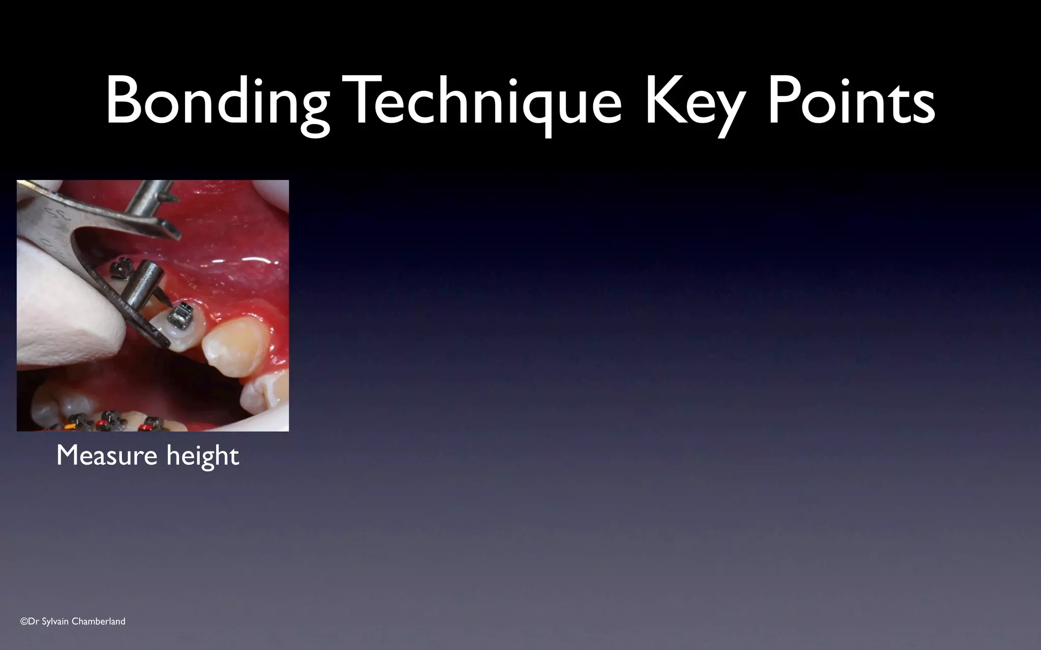 ©Dr Sylvain Chamberland
Bonding Technique Key Points
Measure height
 