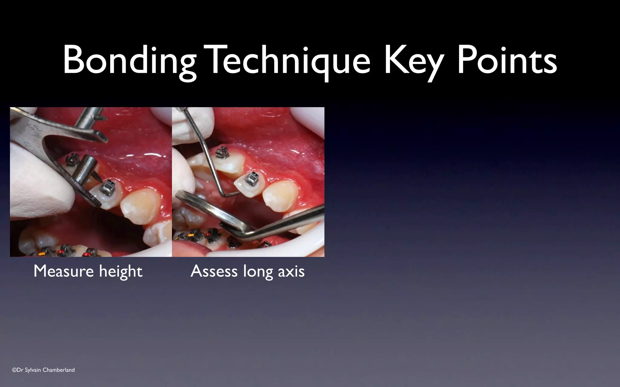 ©Dr Sylvain Chamberland
Bonding Technique Key Points
Measure height Assess long axis
 